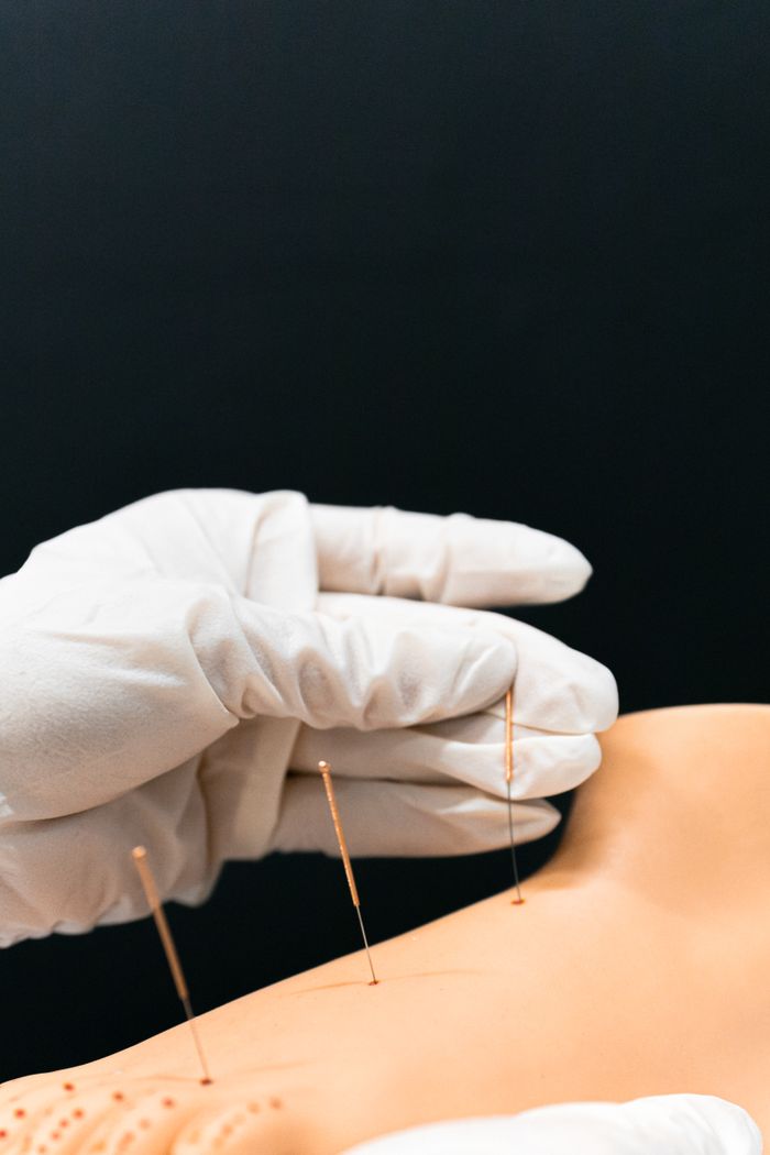 Close-up of a gloved hand performing acupuncture on a model arm with fine needles.