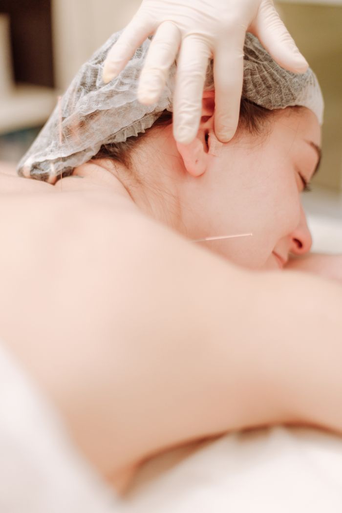 A woman receiving acupuncture therapy for relaxation and wellness, lying down with eyes closed.